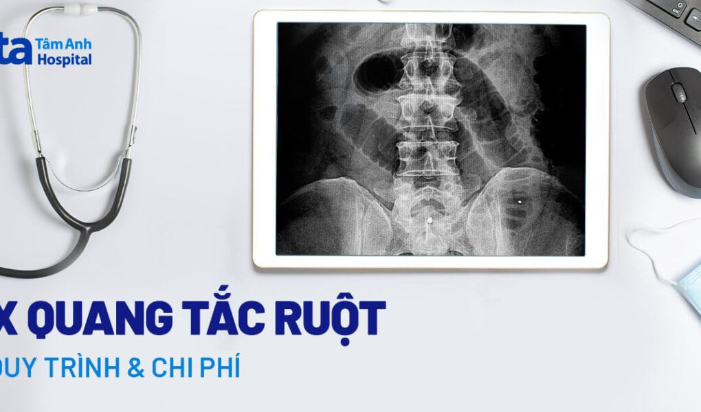 1716450577 Doc vi thong tin Chup X quang tac ruot Quy