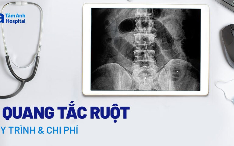 1716450577 Doc vi thong tin Chup X quang tac ruot Quy