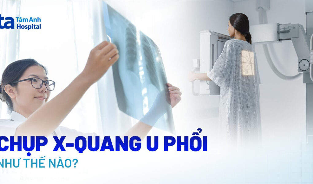 1716452229 Doc vi thong tin Chup X quang tam soat u phoi