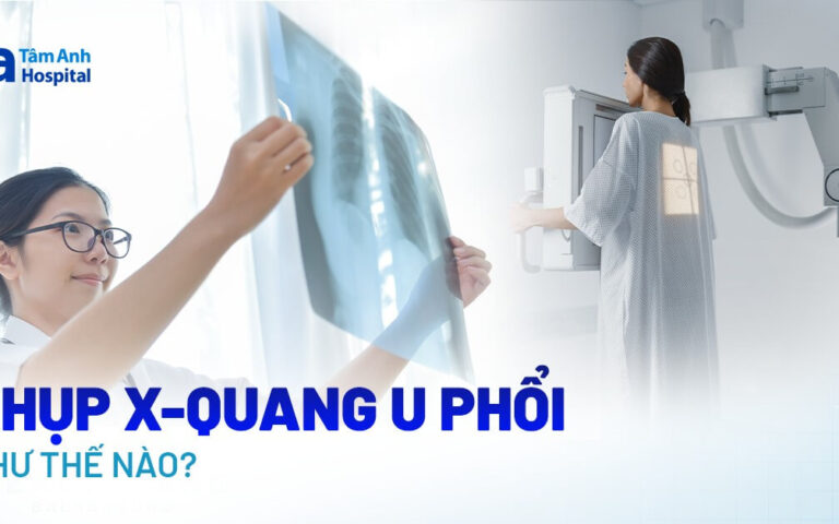 1716452229 Doc vi thong tin Chup X quang tam soat u phoi