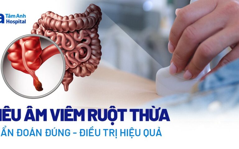 1716466795 Doc vi thong tin Sieu am viem ruot thua Khi