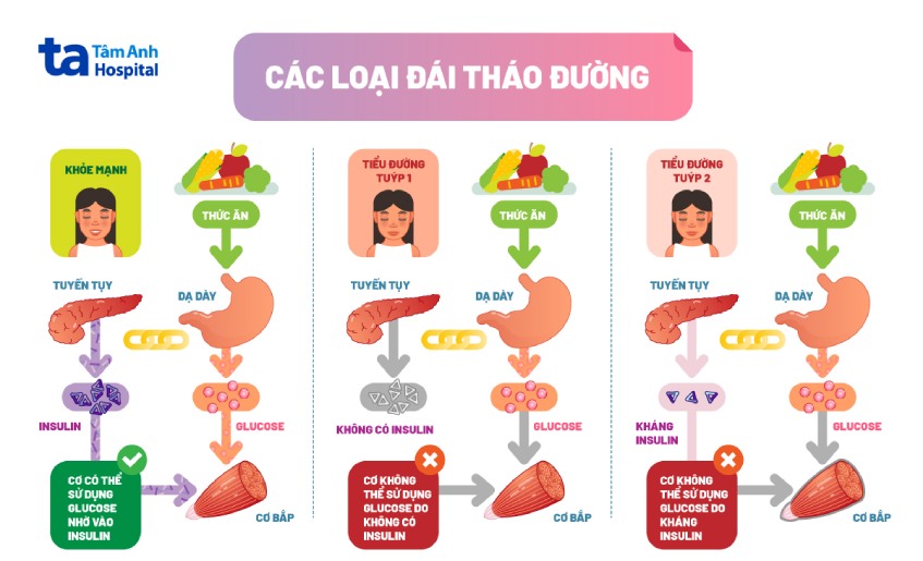 Bệnh tiểu đường ở trẻ em được chia làm hai loại chính