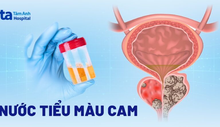 Doc vi thong tin Nuoc tieu mau cam Nguyen nhan