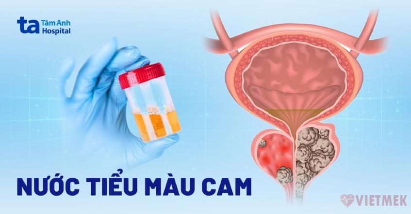 Doc vi thong tin Nuoc tieu mau cam Nguyen nhan