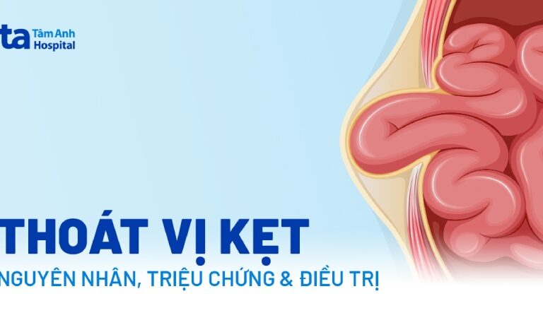 Doc vi thong tin Thoat vi ket Nguyen nhan trieu