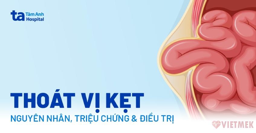 Doc vi thong tin Thoat vi ket Nguyen nhan trieu