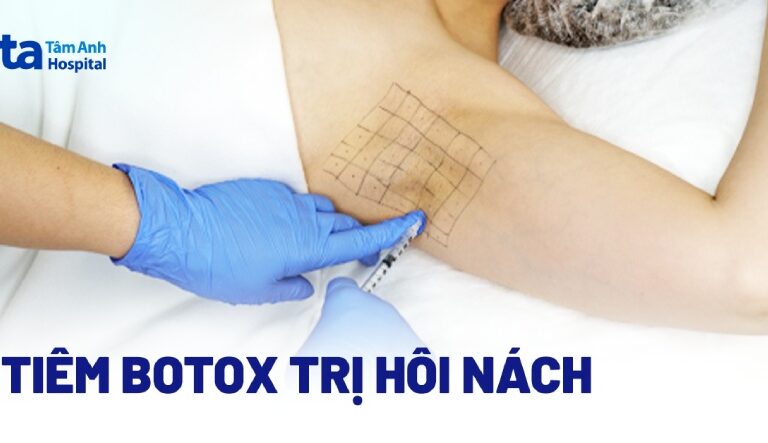 Doc vi thong tin Tiem botox tri hoi nach co