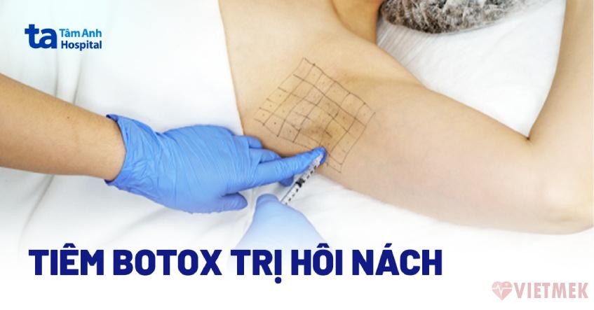 Doc vi thong tin Tiem botox tri hoi nach co