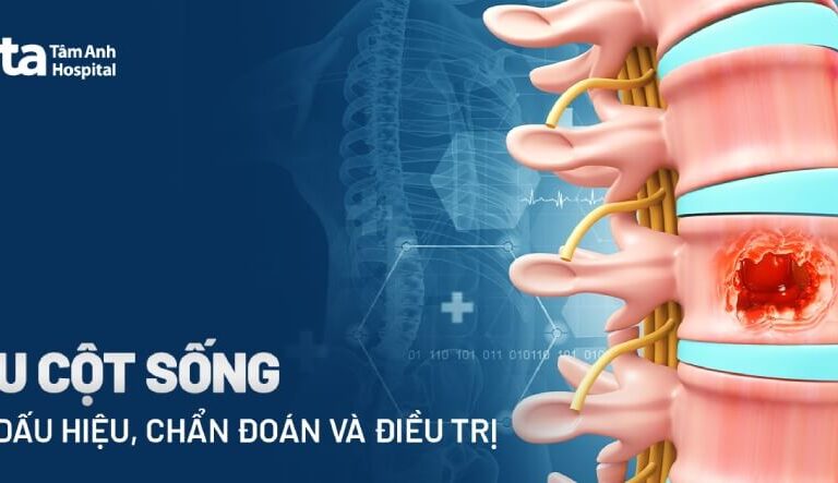 Doc vi thong tin U cot song Dau hieu nguyen