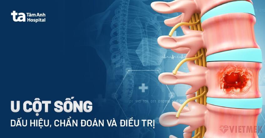 Doc vi thong tin U cot song Dau hieu nguyen