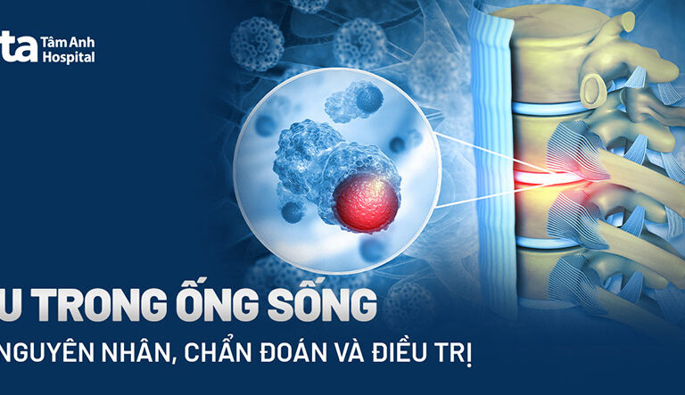 Doc vi thong tin U trong ong song Dau hieu