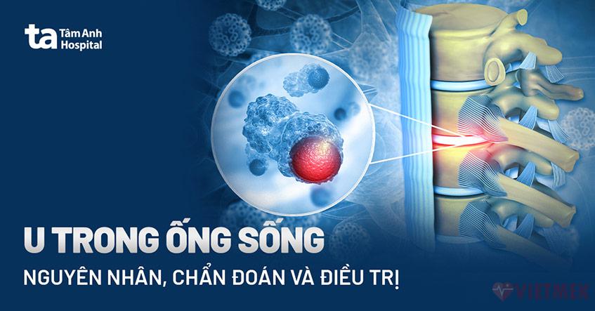 Doc vi thong tin U trong ong song Dau hieu