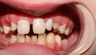 Răng mọc lệch không chỉ ảnh hưởng đến thẩm mỹ mà còn có thể gây ra nhiều vấn đề sức khỏe miệng.