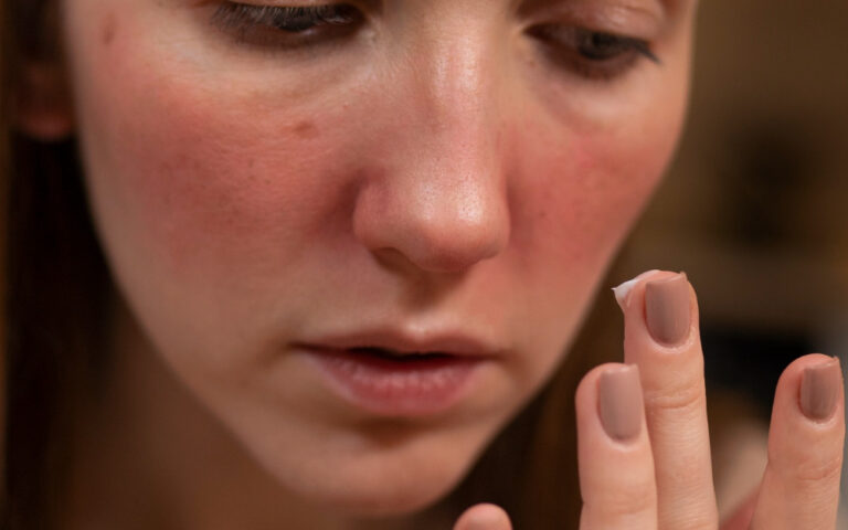 Khám phá nguyên nhân và biện pháp điều trị dị ứng da mặt: bảo vệ làn da, nâng cao sức khỏe