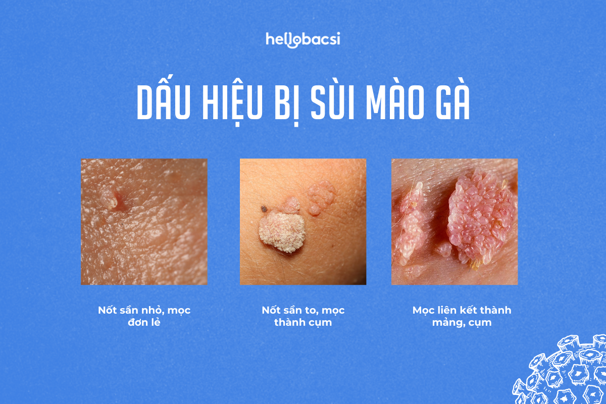 HPV tuýp 6 và 11 thường gặp gây bệnh sùi mào gà