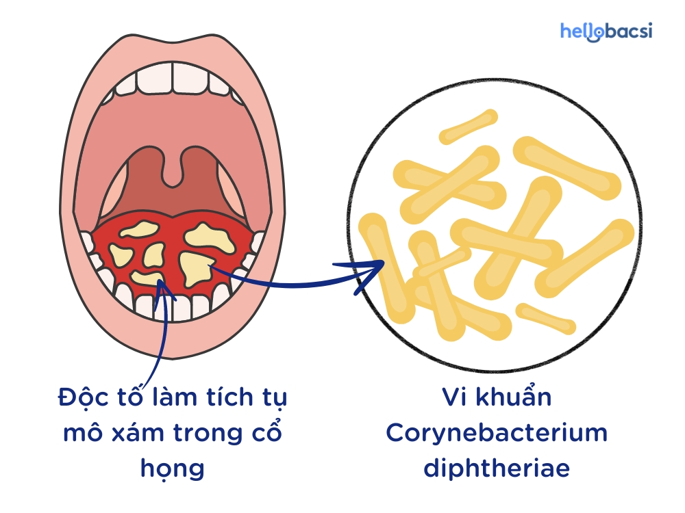 Vắc xin bạch hầu