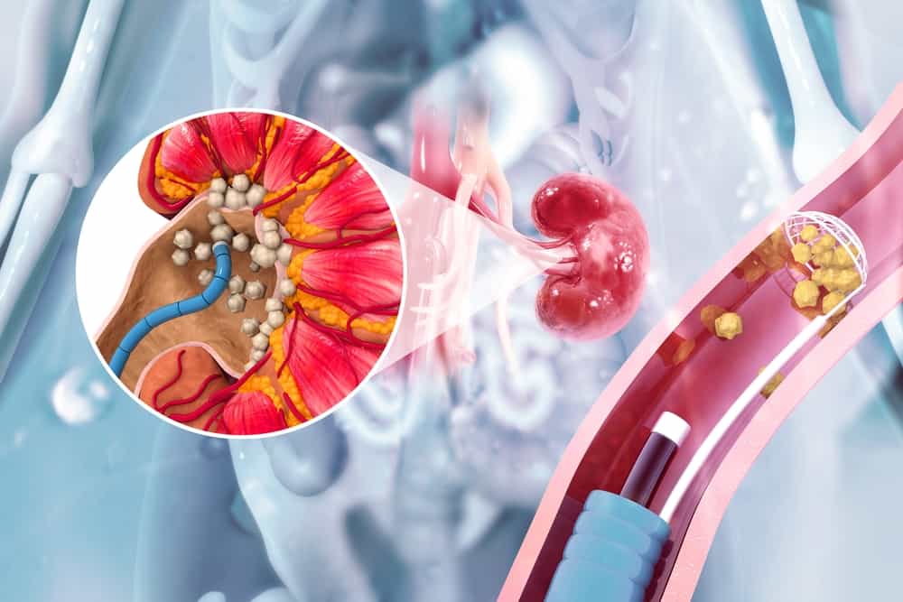 Quá trình phẫu thuật nội soi sỏi thận