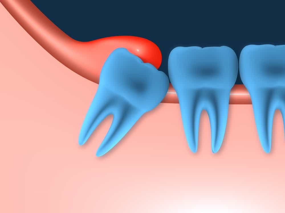 dấu hiệu mọc răng khôn: sưng nướu