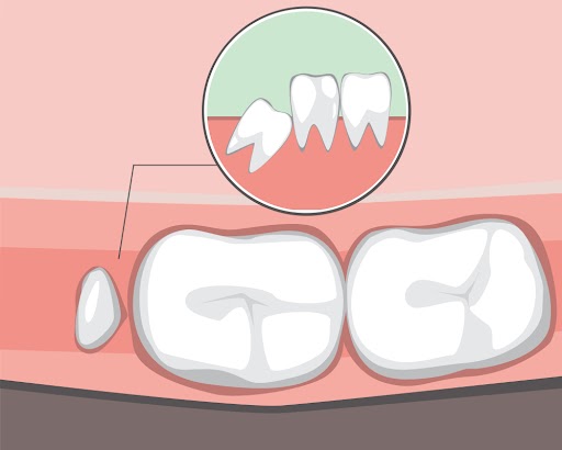 dấu hiệu mọc răng khôn: có đốm trắng ở nướu