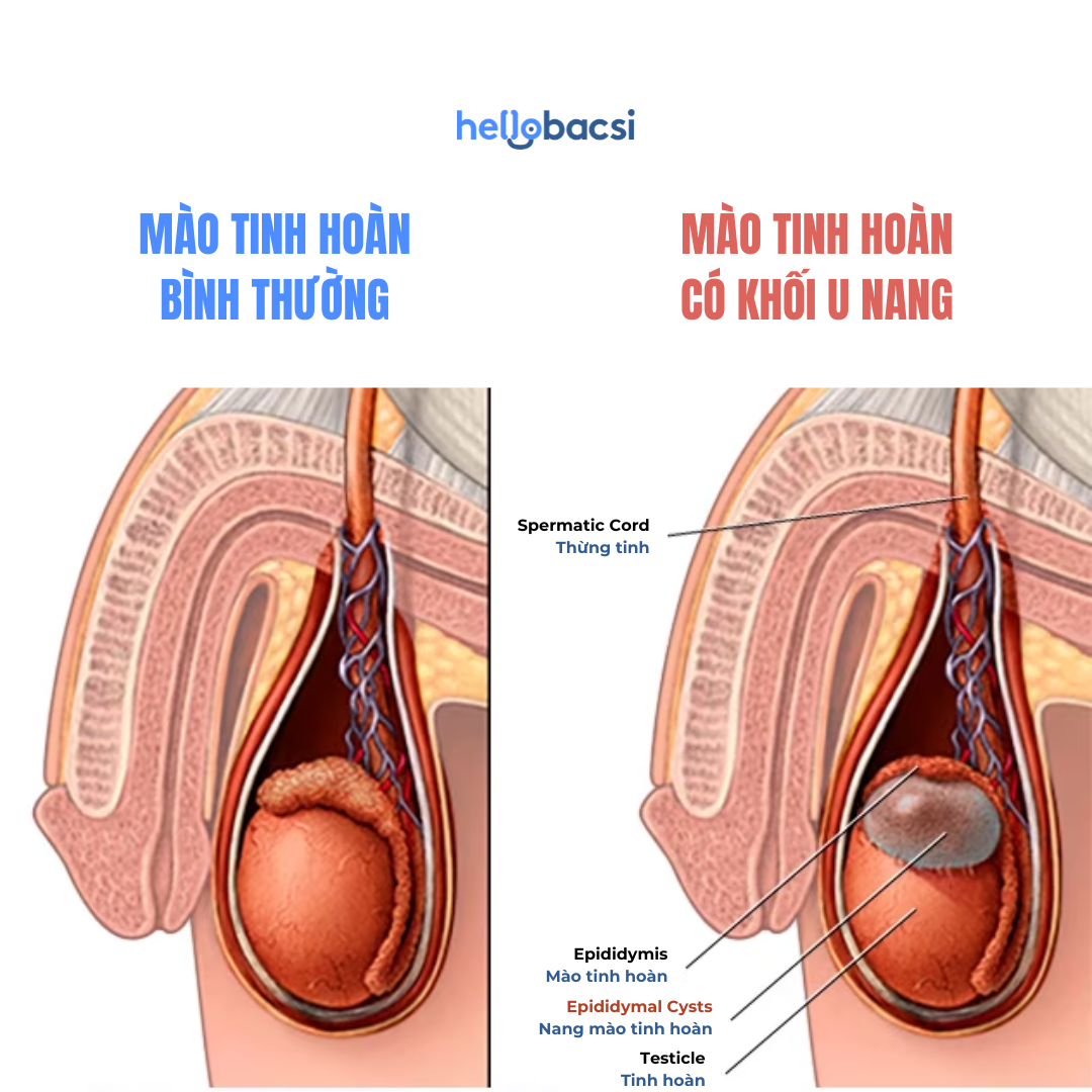 Triệu chứng nang mào tinh hoàn