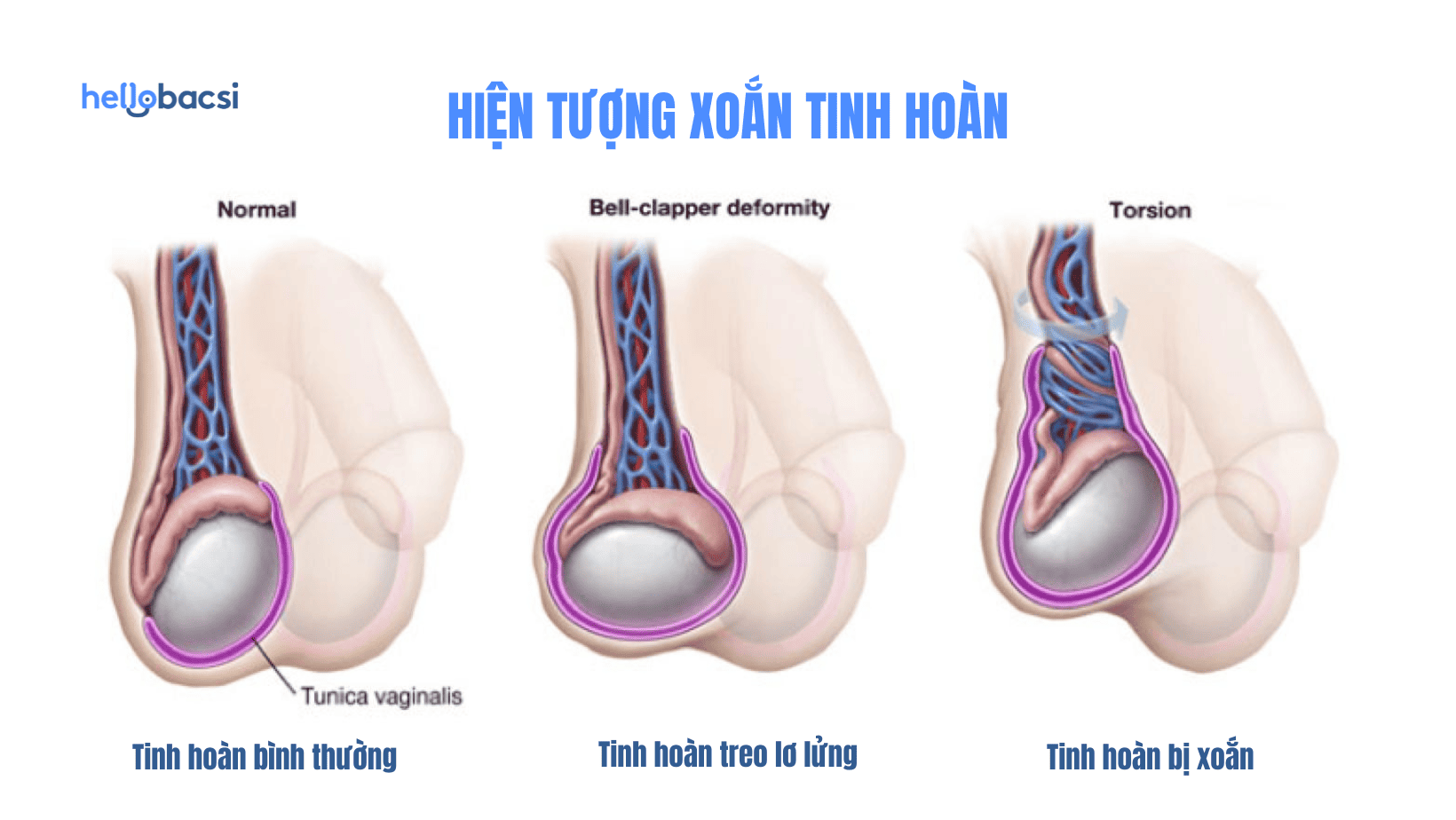 Tinh hoàn bị xoắn có nguy cơ bị teo vĩnh viễn nếu không điều trị kịp thời