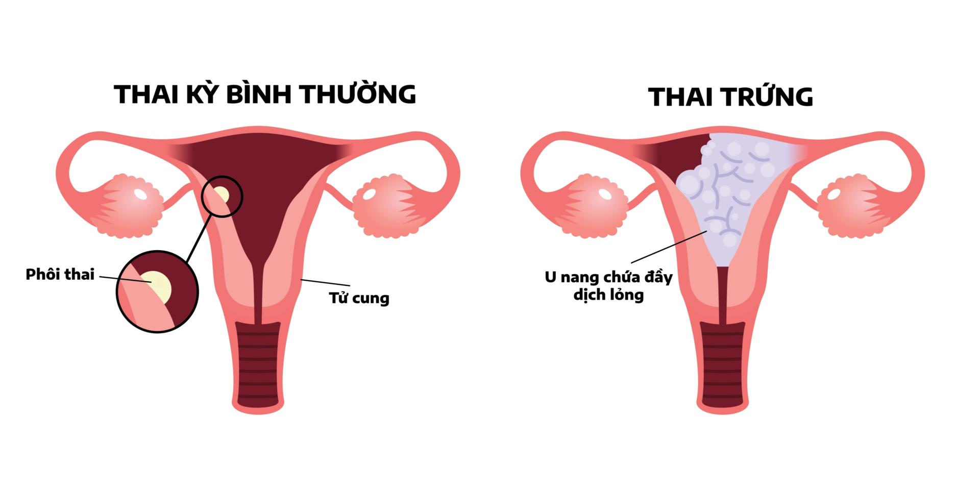 Ban da biet gi ve mang thai trung Chua trung