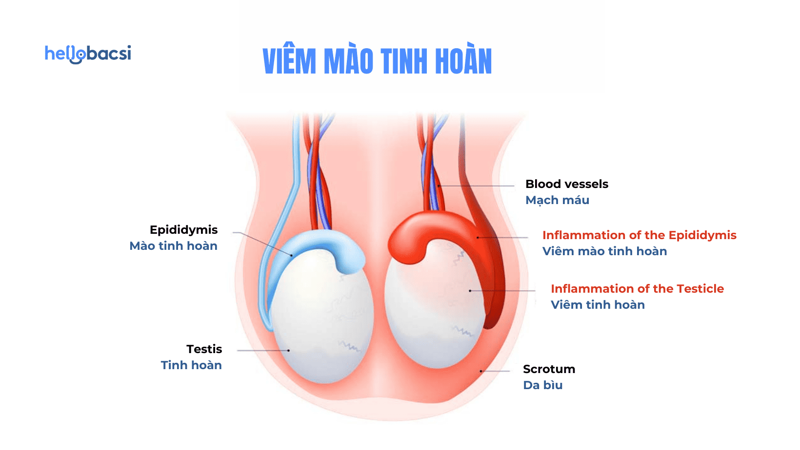 Nguyên nhân gây viêm mào tinh hoàn