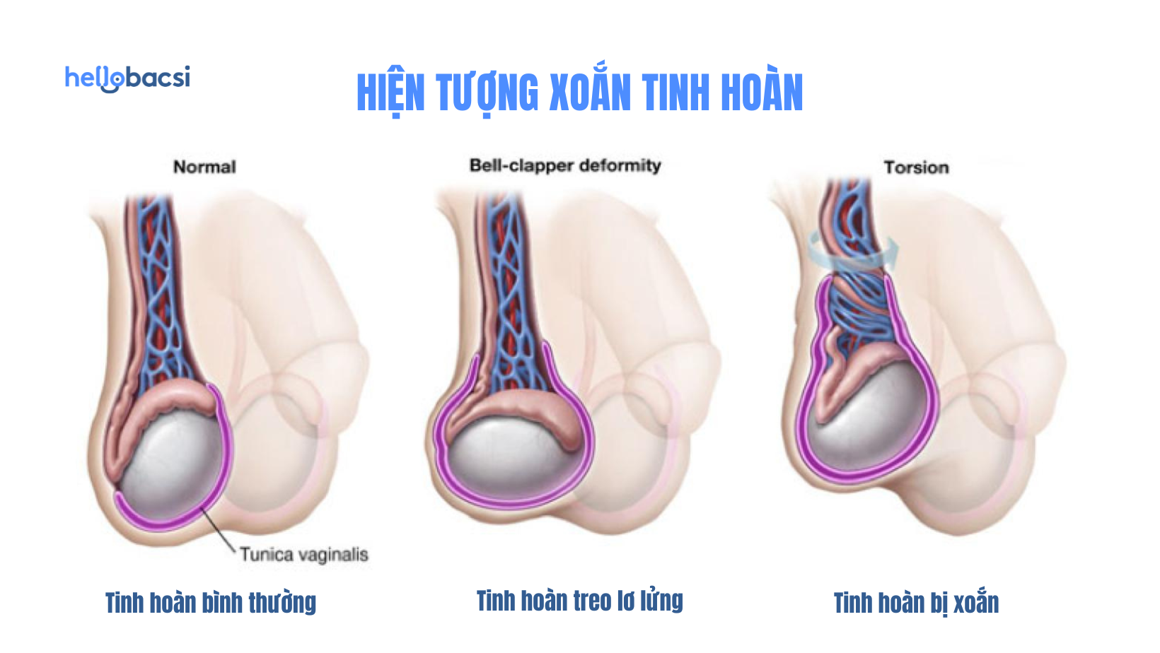 Hieu ro xoan tinh hoan Nguyen nhan trieu chung va