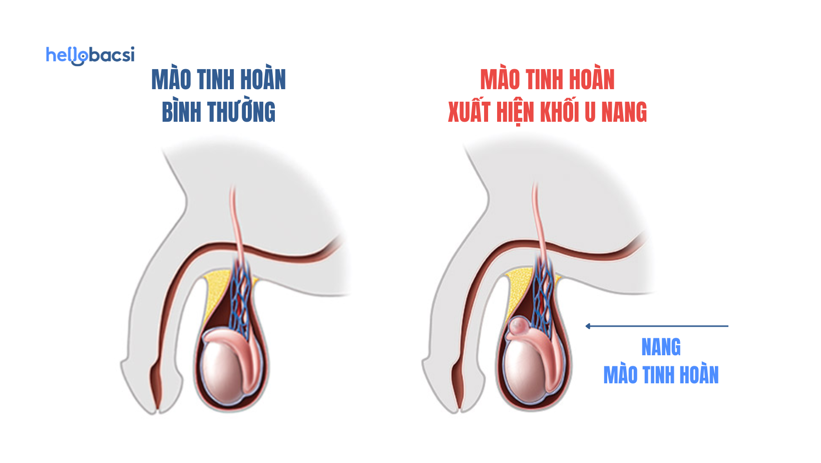 Minh họa đau tinh hoàn bên trái