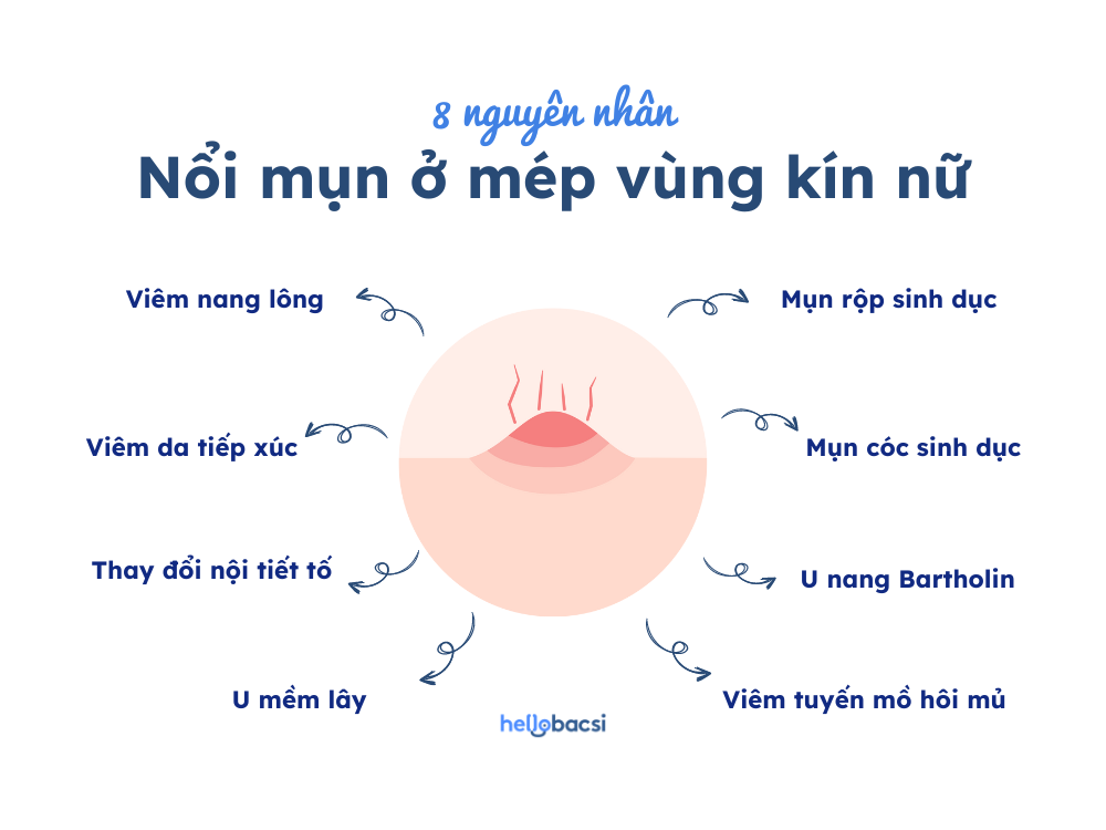 Nguyên nhân nổi mụn ở mép vùng kín nữ