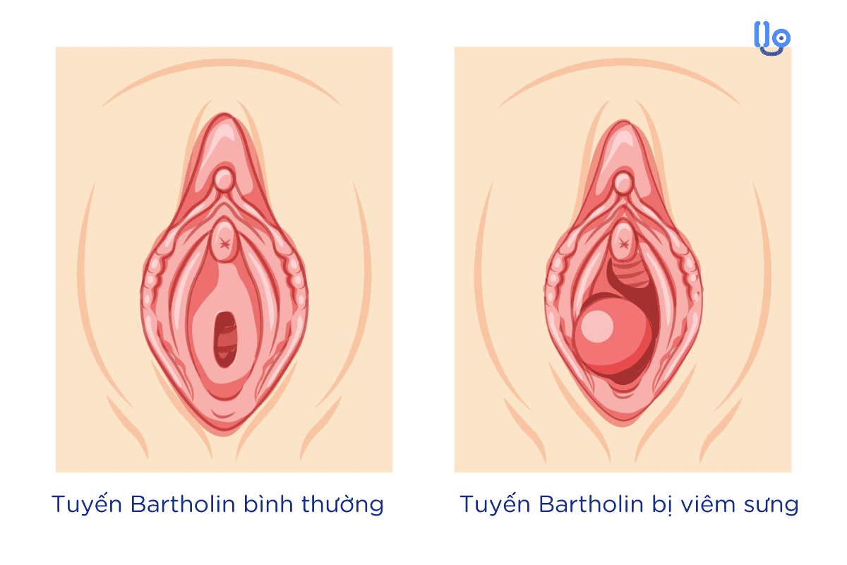 Hình ảnh phân biệt tuyến Bartholin khi bình thường và khi bị viêm